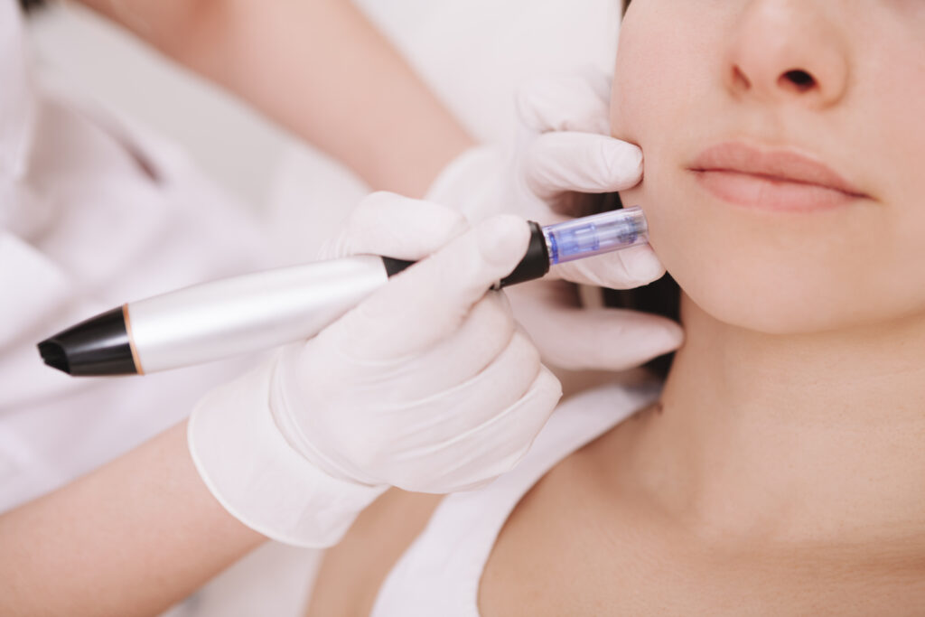 Dermapenを頬に当てられた女性